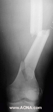 femoral fracture