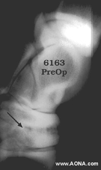 Preoperative lateral projection