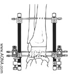Bilateral Knee Frame and Bilateral Ankle Frame