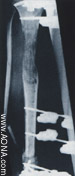 Rectilinear Bone Segment Transportation 
and Leg Strengthening