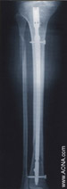 Titanium Tibial Nail - Solid & Cannulated