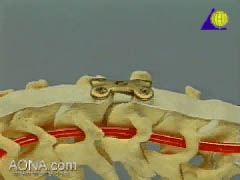 Cervical Spine Locking Plate (CSLP)